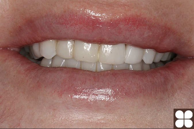 Composite Resin Bonding - Fairfax Cosmetic Dentistry