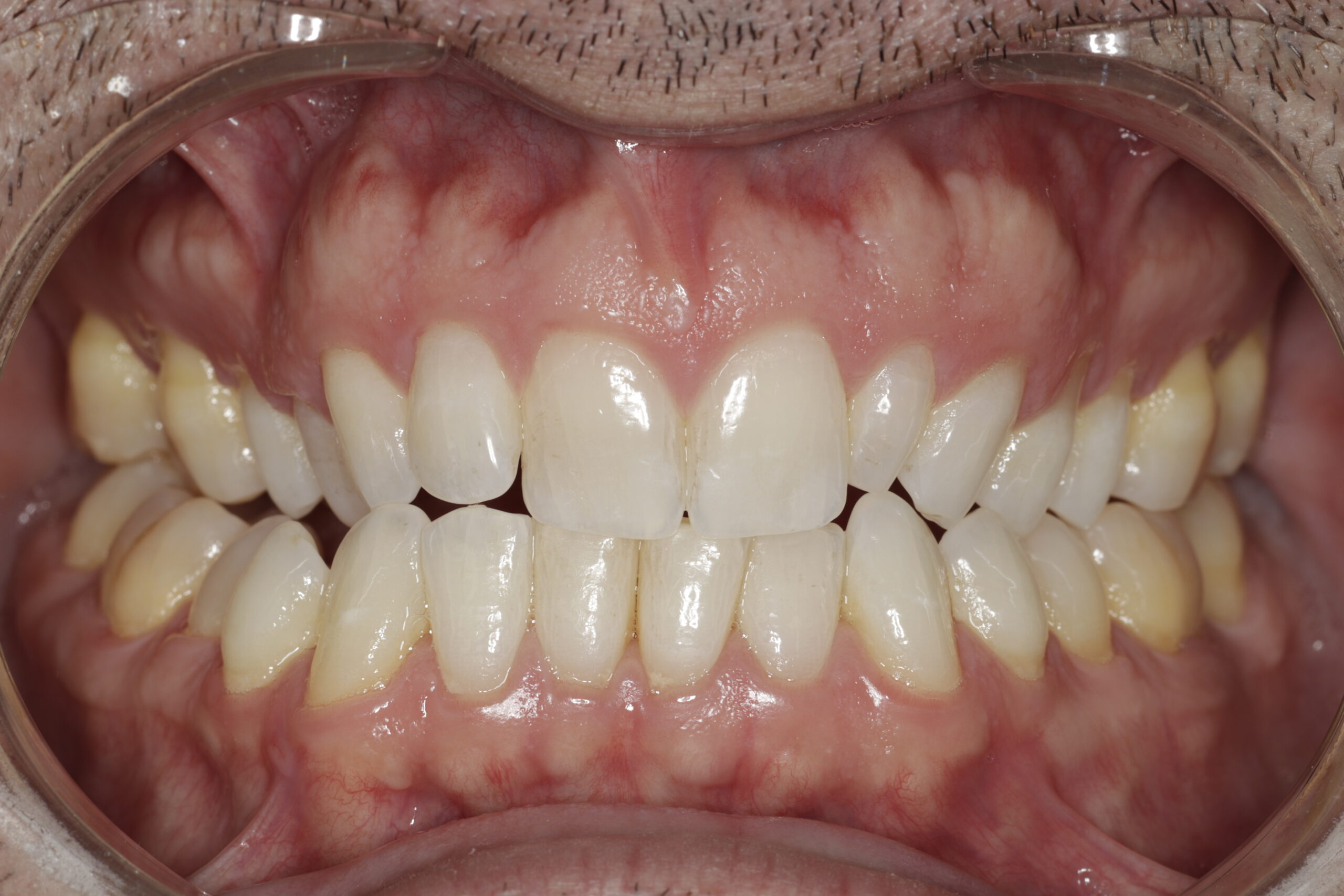 Clear Aligners A Subtle and Flexible Way to Enhance Your Smile scaled