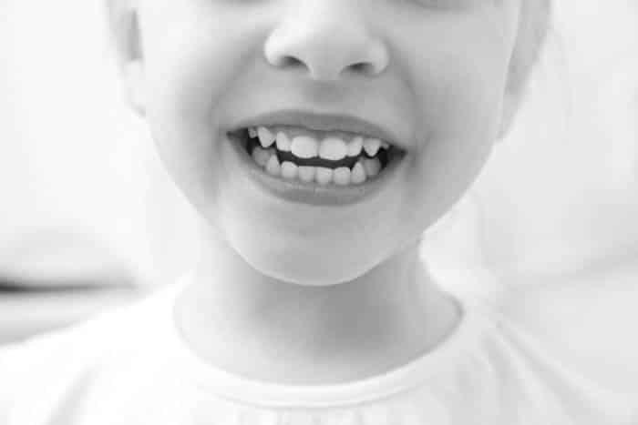 Fair Lakes Family Cosmetic Dentistry Childs Open Mouth Smile