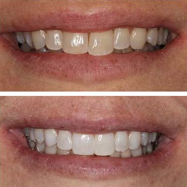 Fair lakes Family and Cosmetic Dentistry Kor Teeth whitening before and after