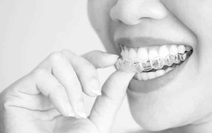 Invisalign Lite vs Full Treatment: Cost, Duration, and Key Differences