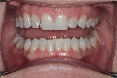 Teeth Whitening Fairfax, VA