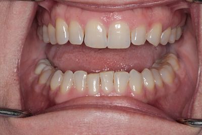 Teeth Whitening Fairfax, VA