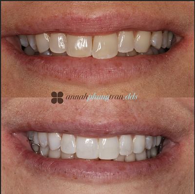 Peroxide vs non peroxide teeth whitening