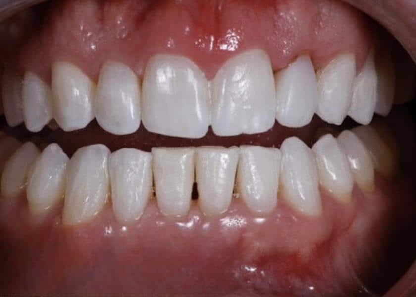after treatment with peg lateral smile results