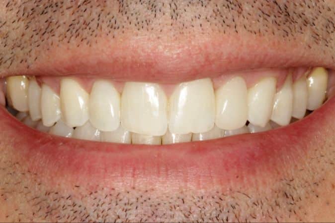 peg laterals after smile