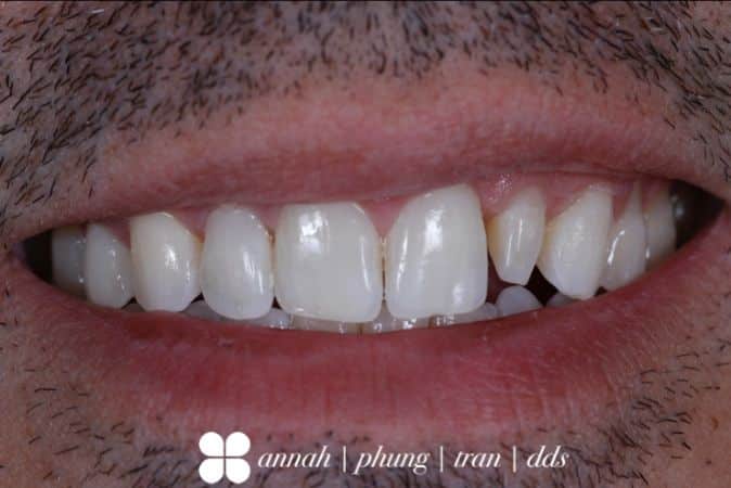 peg laterals before smile