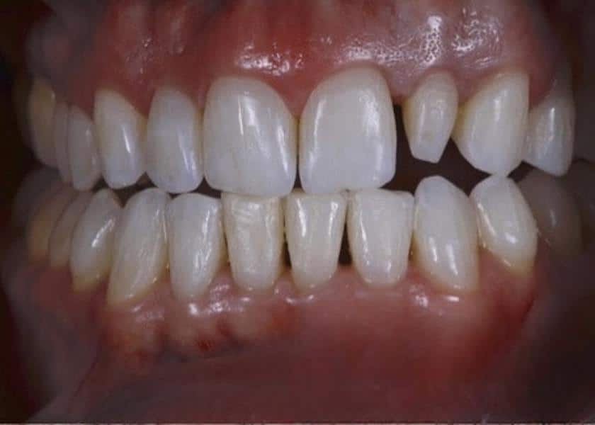 before treatment with peg lateral