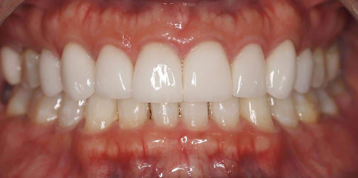 after treatment with veneers smile results