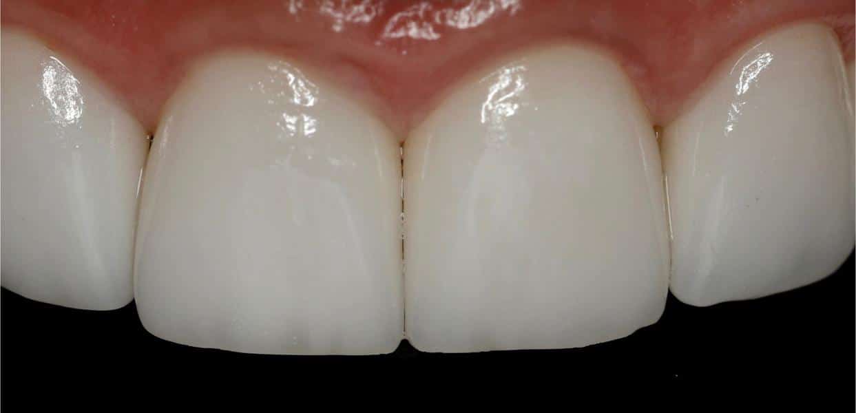 after treatment with veneers results